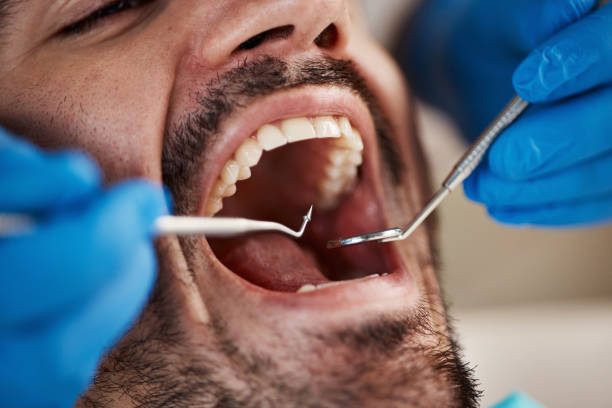 Best Knocked-Out Tooth (Avulsed Tooth) Treatment in Mooresville, IN